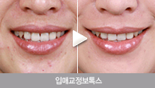 입매교정보톡스