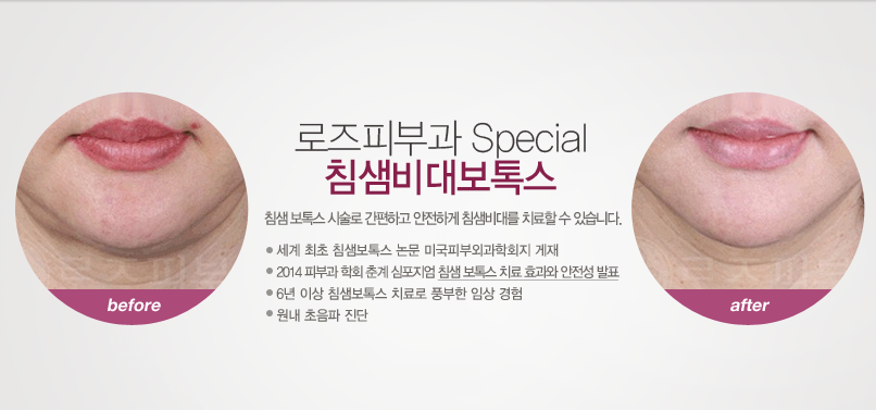 로즈피부과 special 침샘비대보톡스. 침샘보톡스 시술로 간편하고 안전하게 침샘비대를 치료할 수 있습니다.