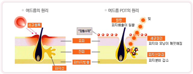 여드름의 원리